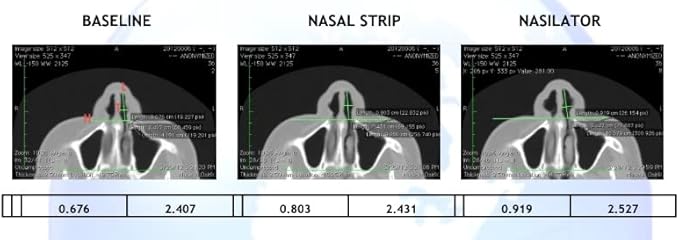 Made in USA! Nasilator Anti-Snoring Devices - Soft and Flexible Nasal Dilators | Improves Breathing & Sleeping | Snoring Solution | Reusable & Better Than Nasal Strips Pack of 4 (Medium)