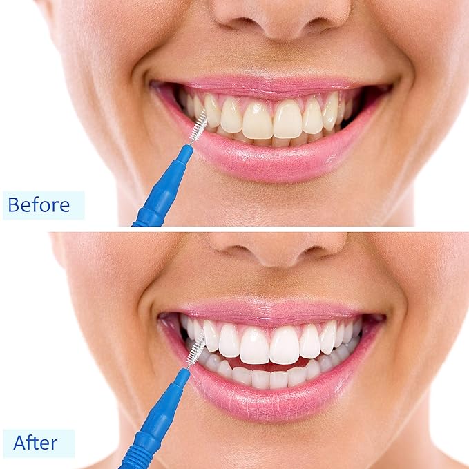 BBTO 100 Pcs Braces Dental Brush Flosser for Cleaner Interdental Brush Toothpick Tooth Flossing Head Oral Dental Toothpick Cleaners Cleaning Tool(Red and Blue)