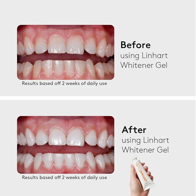 LINHART Teeth Whitening Kit with LED Light - Tooth Whitener Gel, Dental Whitening Gel Syringes with 35% Carbamide Peroxide and 16-Led Whitening Light - No Sensitivity, Whitens Teeth