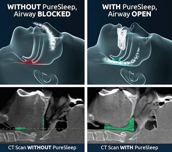 PureSleep, The Original Anti-Snoring Mouthpiece and #1 Solution Worldwide