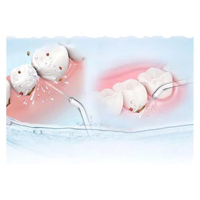 Replacement Refill Tips, Compatible For WATERPIK, For Water Flosser And Other Brand Irrigator