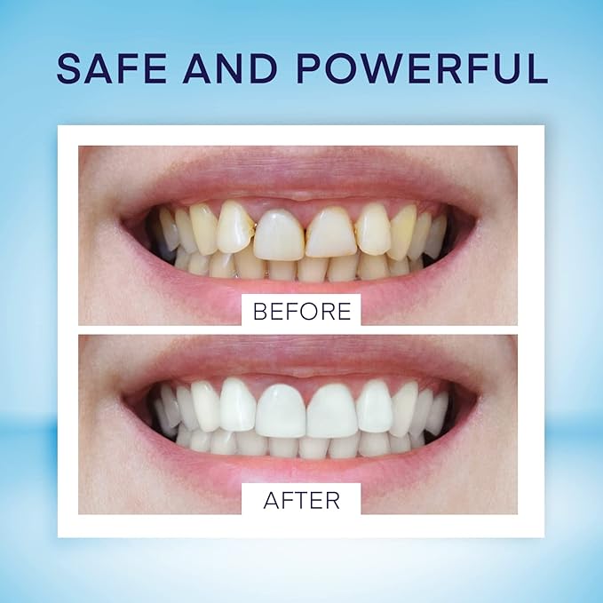 Teeth Whitening Pen (4 Pens) for Teeth Whitening, 40+ Uses, Effective, Painless, No Sensitivity, Travel-Friendly, Beautiful White Smile, Mint Flavor