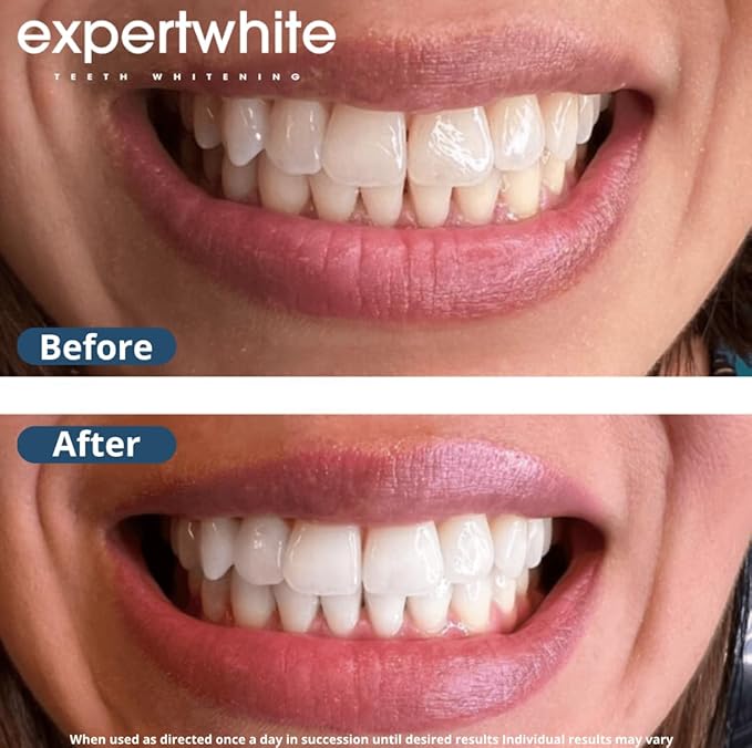 Teeth Whitening Gel Refills (6-gels). Made USA. 44 percent Carbamide Peroxide Tooth Bleaching Gel bleach For Invisalign style trays, Dental Grade Tooth Whitener. 6 syringes