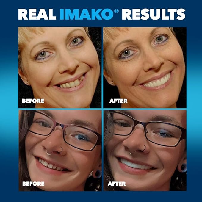 Imako Premium Cosmetic Uppers - 1 Pack - Small, Natural White - DIY Smile Makeover - Made in USA