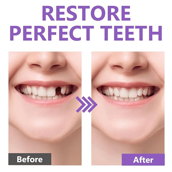 Temporary Tooth Repair Kit - Moldable Teeth-Filling Repair Kit, DIY at Home, With 4 Shaping Tools