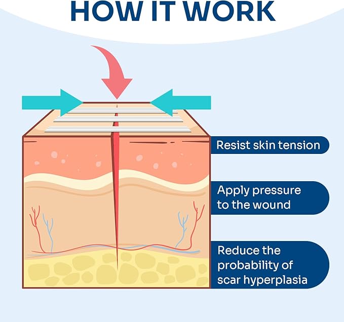 Conkote Wound Closure, Breathable Strips Hold Small Wounds Firmly Closed, Great After Sutures or Staples - 40 Wound Closures