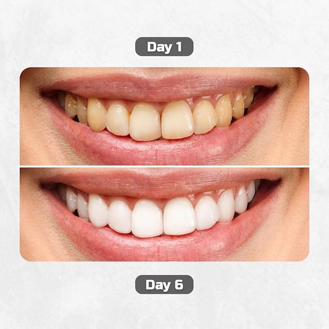 Teeth Whitening Gel Pen - Best Teeth Whitening Kit with Gel Pen Teeth Whitener 30+ Uses, Effective, Painless, No Sensitivity, Beautiful White Smile