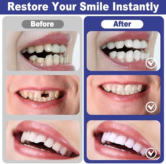 Temporary Tooth Provisional Kit - DIY Heat Beads for Missing or Broken Teeth, Dental Restoration & Replacement