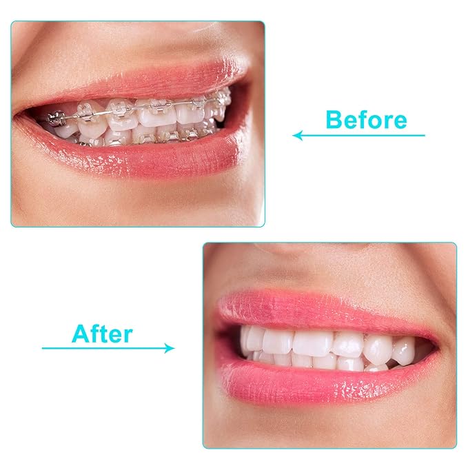 20 Pieces Aligner Tray Seaters for Aligner Trays Chompers Orthodontic Trays(Light Pink, Red, Green, Lavender, Light Yellow)