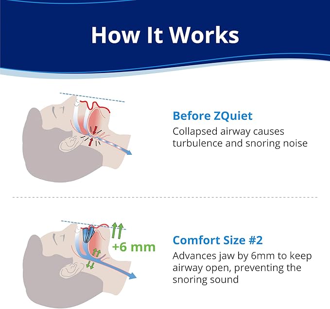 ZQuiet, Anti-Snoring Mouthpiece, Comfort Size#2, Single Refill, Clear, Made in USA, BPA-Free, Medical-Grade Material