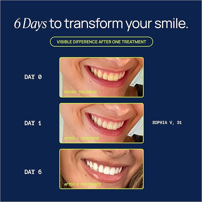 Laughland Super Strength Teeth Whitening Kit, Phone-Powered LED Mouthpiece & 3 Whitening Gel Syringes, 11% Hydrogen Peroxide, Glycerin, Aloe Vera & Mint, at Home Dental Care, 6+ Treatments