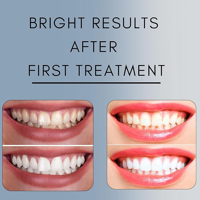 Teeth Whitening Gel for Trays - Professional Strength 44% Carbamide Peroxide, 5 Syringes (50 Treatments) + 2 Trays – Enamel Safe, Removes Coffee & Other Stains