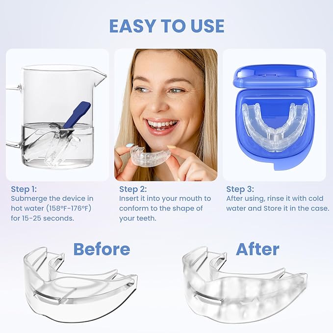 S martGuard Anti-Snore Device: Anti-Snoring Device for Stop Snoring Solution for Men and Women-U01