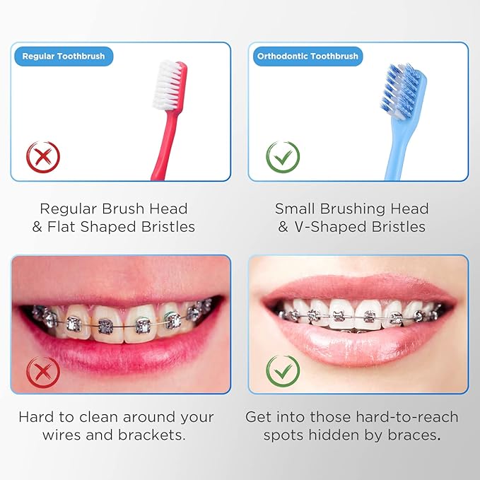V-Shaped Orthodontic Toothbrush for Braces, Soft Bristles, 6 Count