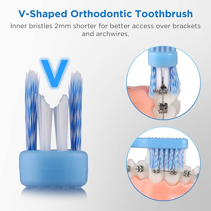 V-Shaped Orthodontic Toothbrush for Braces, Soft Bristles, 6 Count