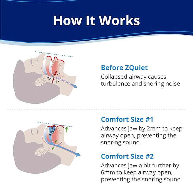 ZQuiet, Anti-Snoring Mouthpiece (Blue) + Cleaner (1.5oz Bottle), Starter Pack with 2 Sizes, Made in USA, BPA-Free, Medical-Grade Material