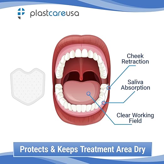 200 Dental Dry Corners, Disposable Saliva Control & Cheek Protection Pads Super Absorbent Non-Woven Padding (Cotton Roll Alternative) (Large)