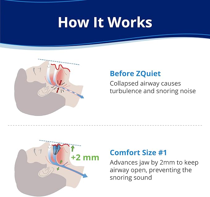 ZQuiet, Anti-Snoring Mouthpiece, Comfort Size #1, Single Refill, Blue, Made in USA, BPA-Free, Medical-Grade Material