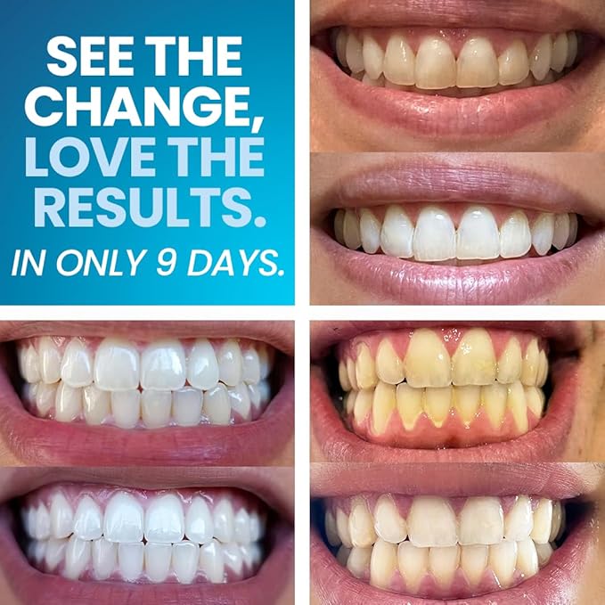 Emerawhite Teeth Whitening Kit - Personalized 9-Day Tooth Whitener - Professional Snow Whitening for Radiant Smiles | Enamel Safe