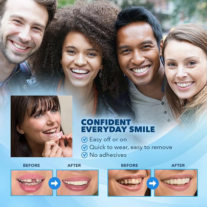 Imako Premium Cosmetic Uppers - 1 Pack - Large, Bleached White - DIY Smile Makeover - Made in USA